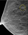 乳房X線撮影装置：撮影時02